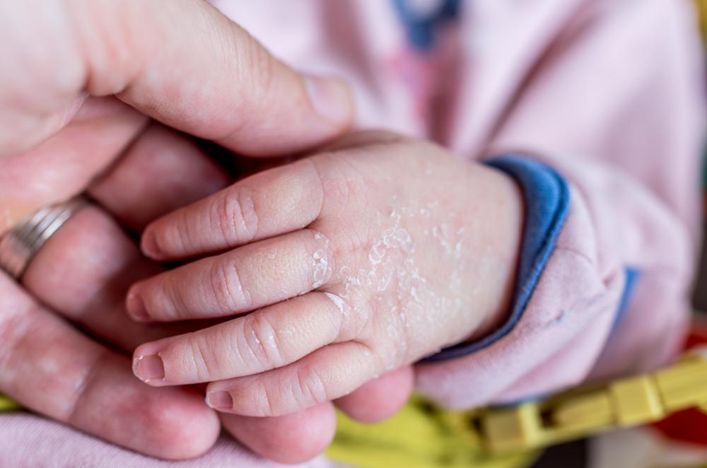 Почему шелушится кожа у ребенка: причины, симптомы и диагностика